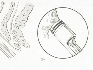 legatura-elastica_fig1