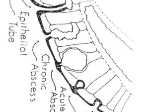 sinus-pilonidalis_1a