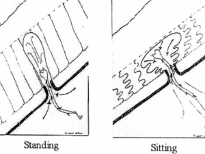 sinus-pilonidalis_1b