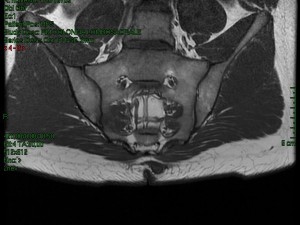 sinus-pilonidalis_4a