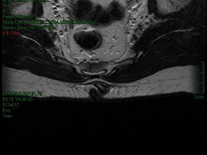 sinus-pilonidalis_4c