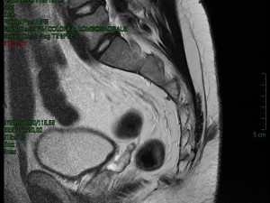 sinus-pilonidalis_4d