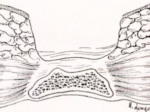 sinus-pilonidalis_5